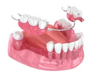 How To Whiten Dentures wear
